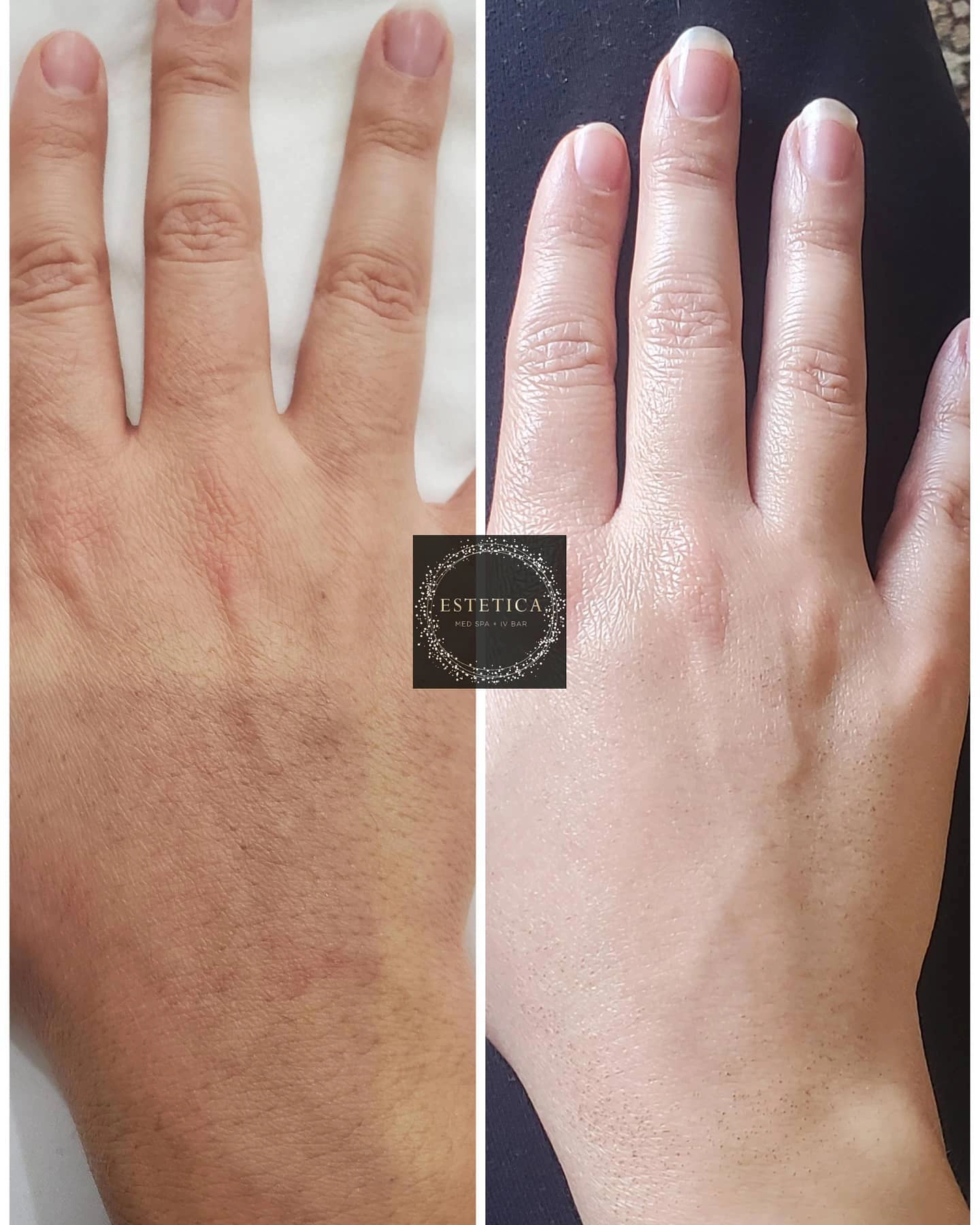 Hand Radiesse copy - Cult Med Spa - Cult Med Spa Radiesse in hand